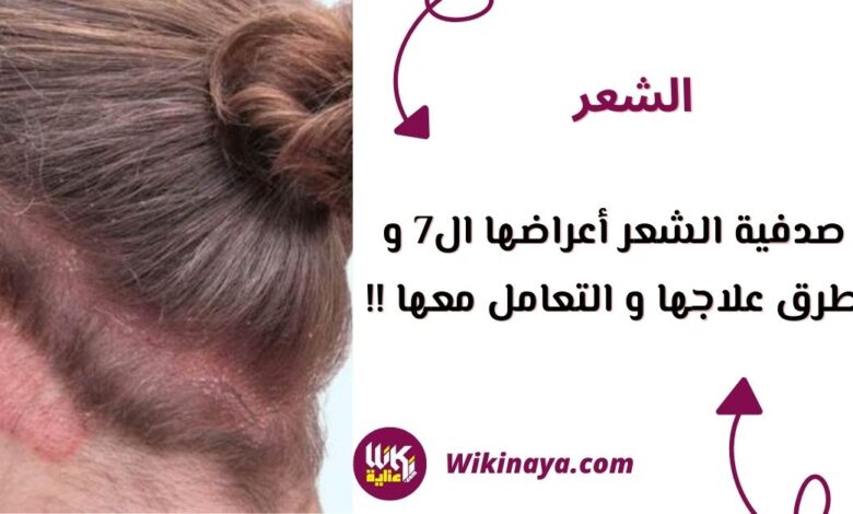 صدفية الشعر أعراضها ال7 و طرق علاجها و التعامل معها !!