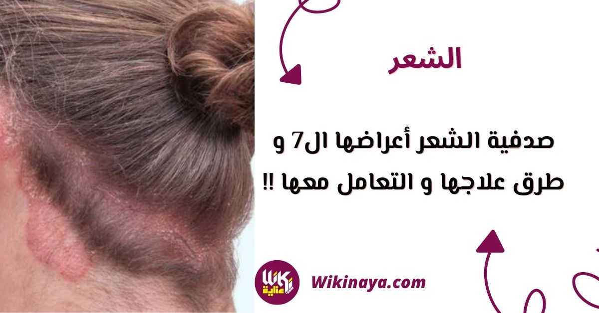 صدفية الشعر أعراضها ال7 و طرق علاجها و التعامل معها !!