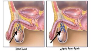 صورة موضحة لاحتقان الدم