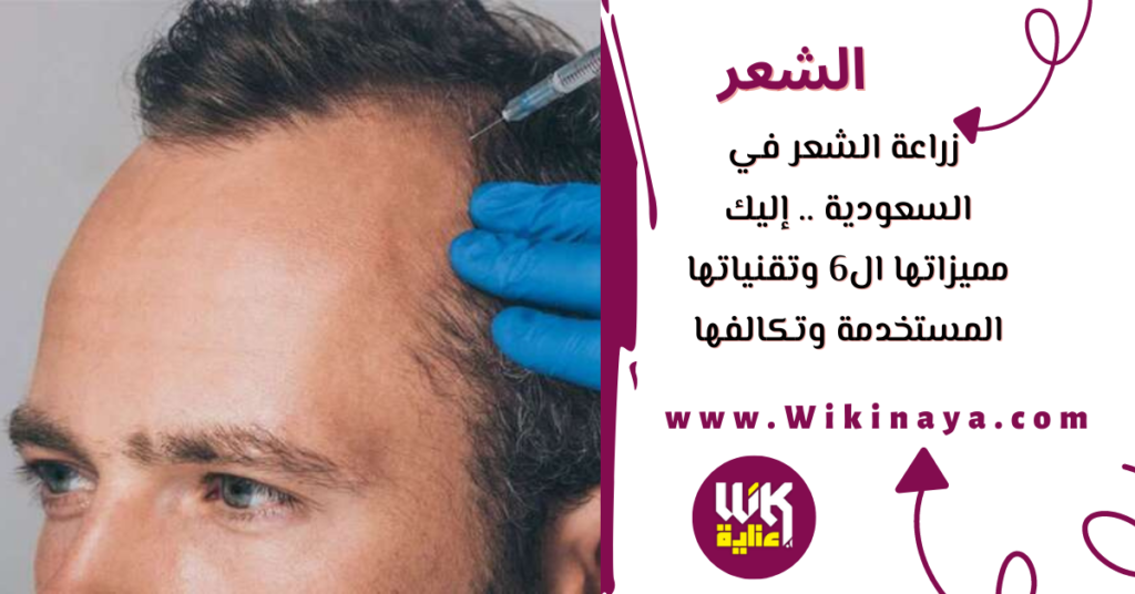 زراعة الشعر في السعودية