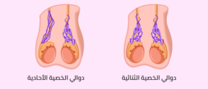 دوالي الخصية الثنائية ودوالي الخصية الأحادية