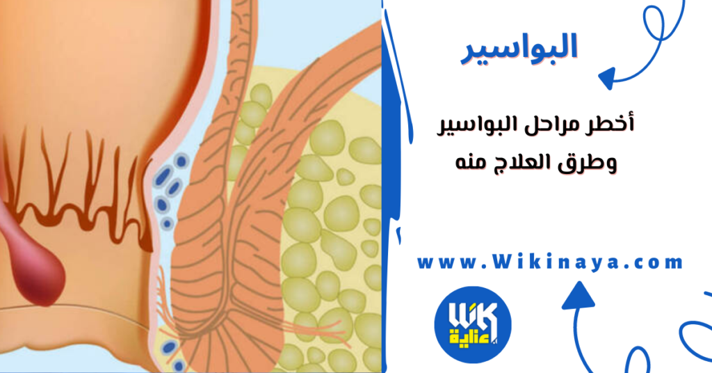 أخطر مراحل البواسير