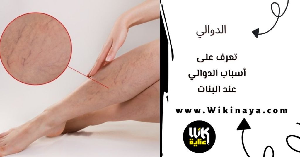 تعرف على أسباب الدوالي عند البنات