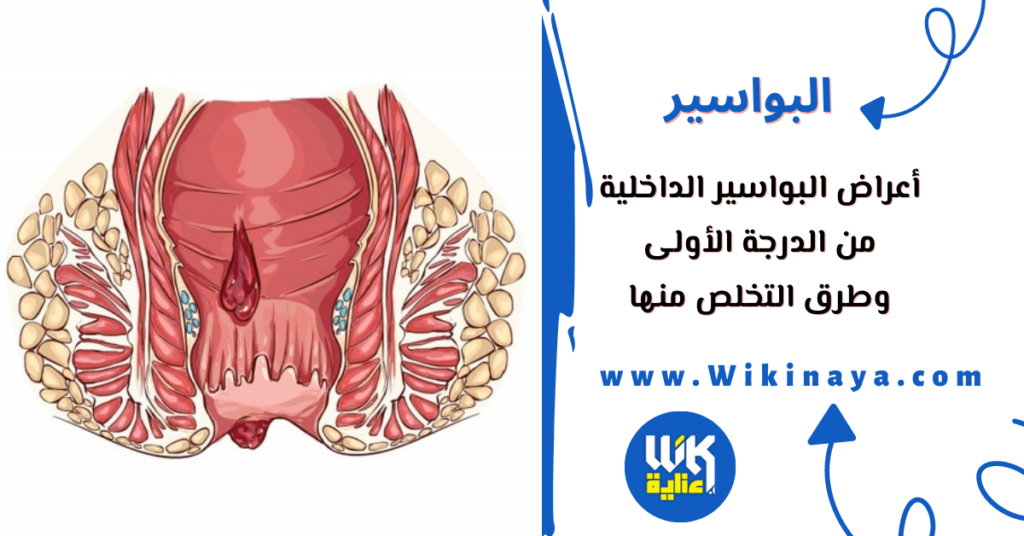 أعراض البواسير الداخلية من الدرجة الأولى