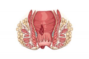 أعراض البواسير الداخلية من الدرجة الأولى