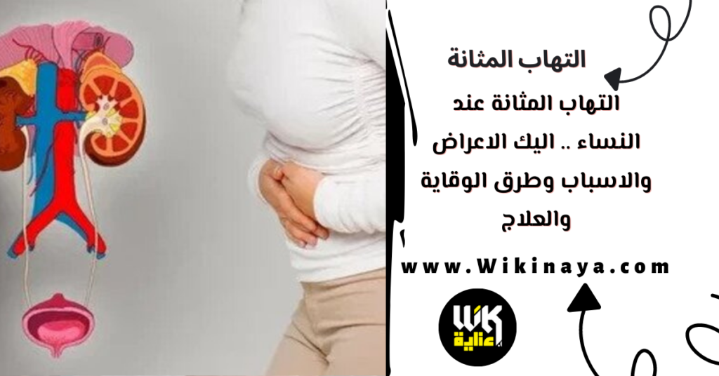 التهاب المثانة عند النساء