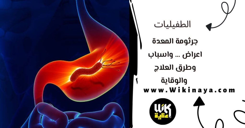 جرثومة المعدة اعراض … واسباب وطرق العلاج والوقاية