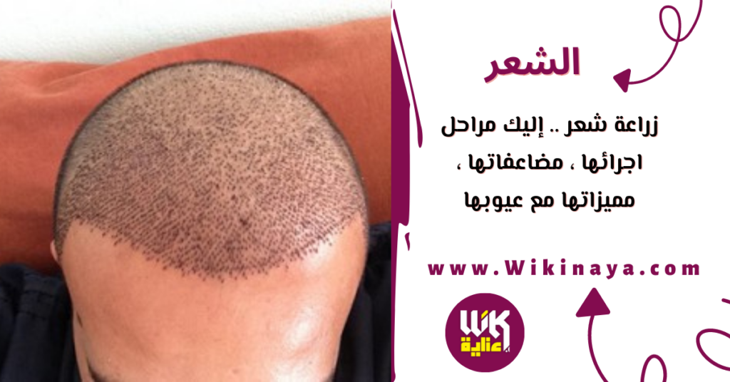 زراعة شعر