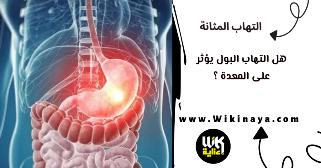 هل التهاب البول يؤثر على المعدة ؟