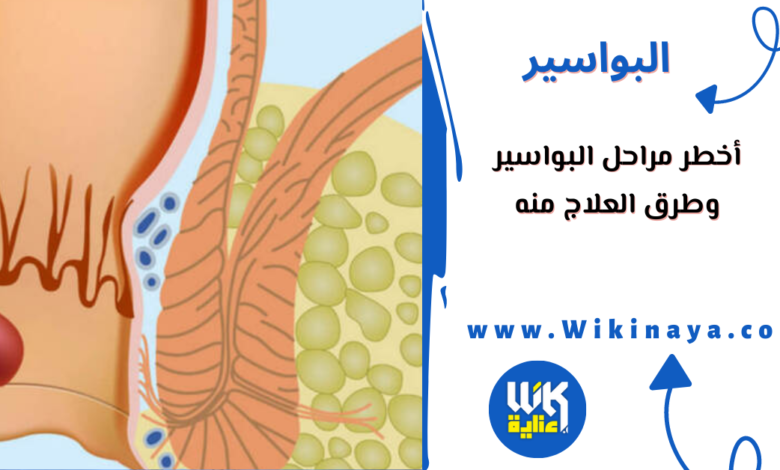 أخطر مراحل البواسير