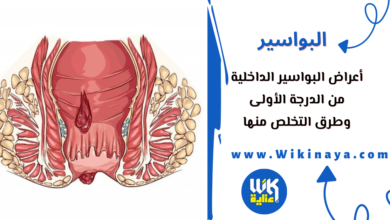 أعراض البواسير الداخلية من الدرجة الأولى