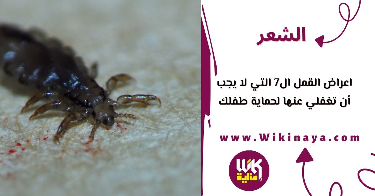 اعراض القمل ال7 التي لا يجب أن تغفلي عنها لحماية طفلك