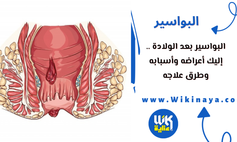 البواسير بعد الولادة