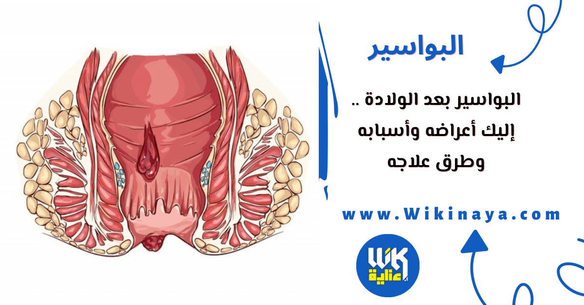 البواسير بعد الولادة