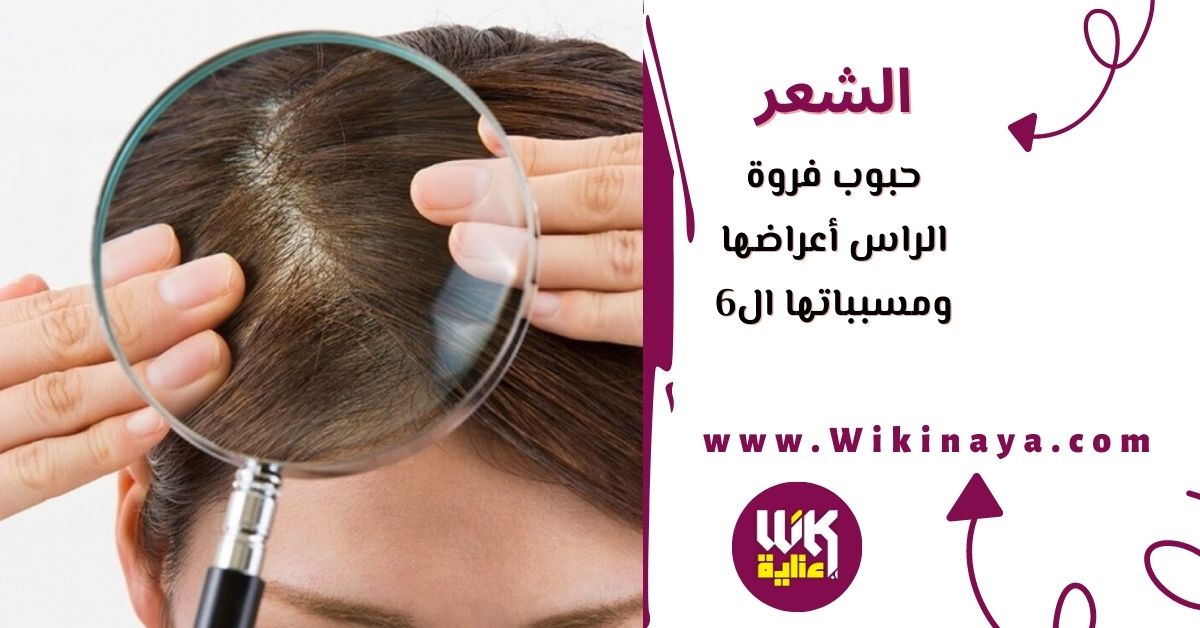 حبوب فروة الراس أعراضها ومسبباتها ال6