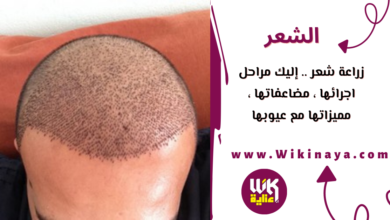 زراعة شعر