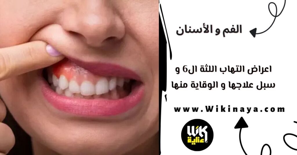 اعراض التهاب اللثة ال6 و سبل علاجها و الوقاية منها