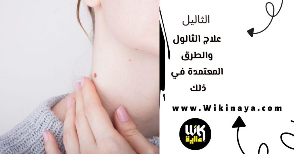 علاج الثالول والطرق المعتمدة في ذلك