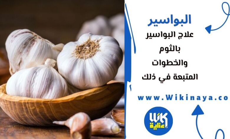 علاج البواسير بالثوم والخطوات المتبعة في ذلك