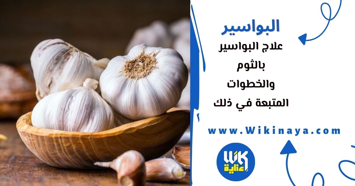 علاج البواسير بالثوم والخطوات المتبعة في ذلك