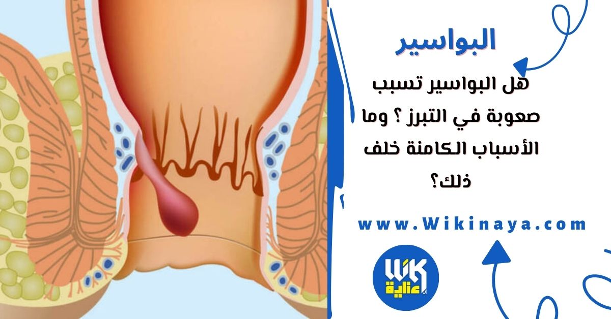 هل البواسير تسبب صعوبة في التبرز ؟ وما الأسباب الكامنة خلف ذلك؟