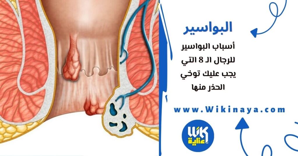 أسباب البواسير للرجال ال 8 التي يجب عليك توخي الحذر منها