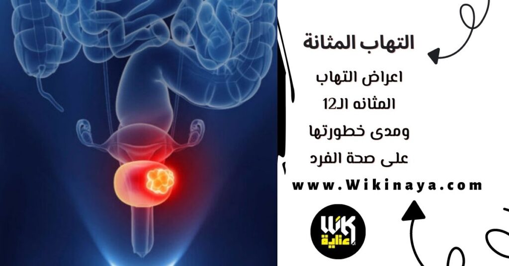 اعراض التهاب المثانه الـ12 ومدى خطورتها على صحة الفرد