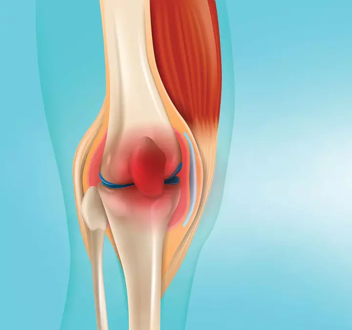 التهاب المفاصل ... اعراضه ال 11 واسبابه وطرق العلاح والوقاية منه