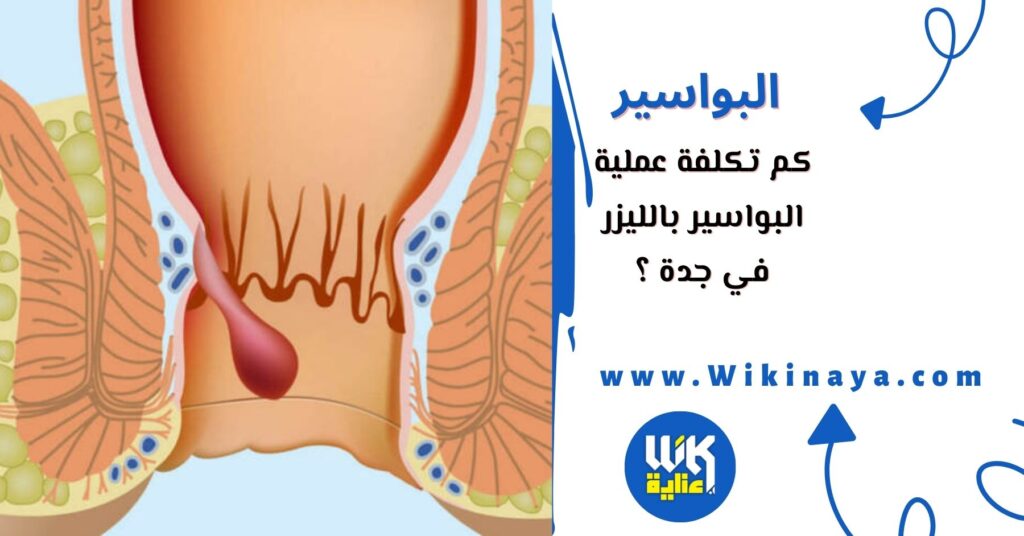 كم تكلفة عملية البواسير بالليزر في جدة ؟