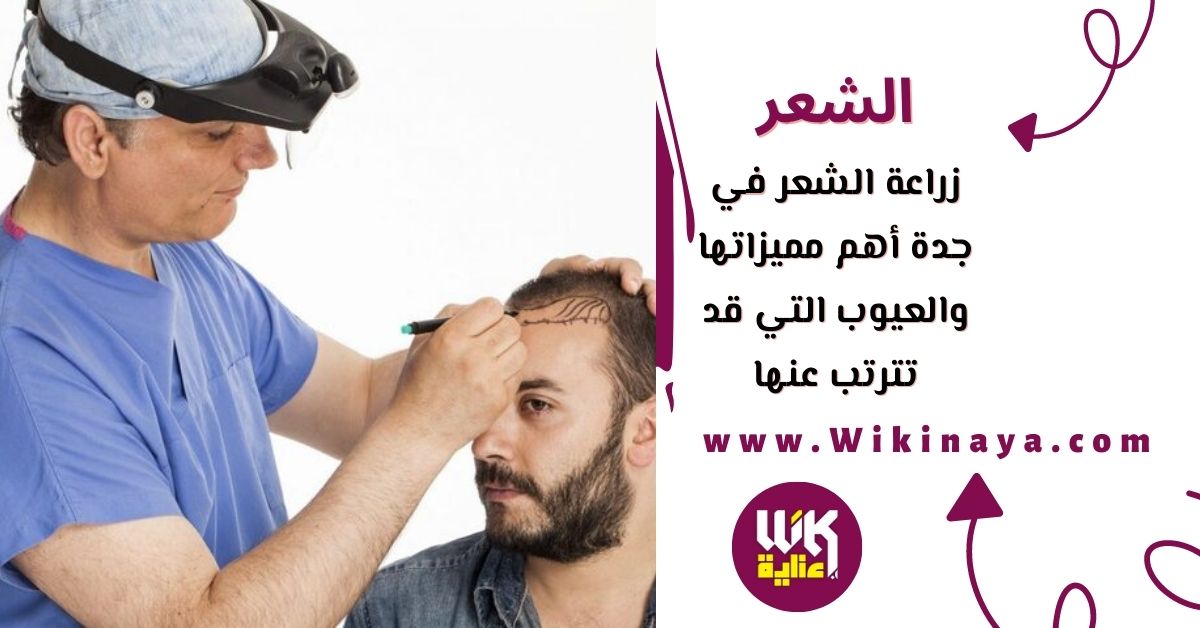 زراعة الشعر في جدة أهم مميزاتها والعيوب التي قد تترتب عنها