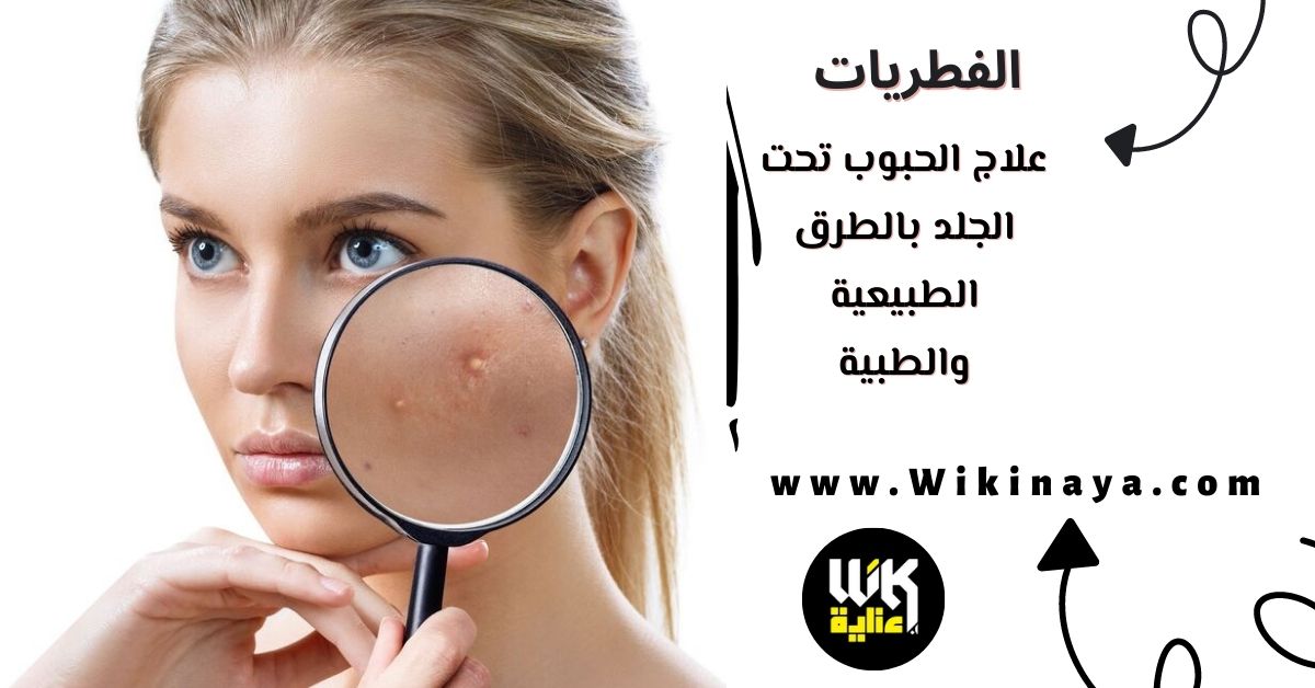 علاج الحبوب تحت الجلد بالطرق الطبيعية والطبية