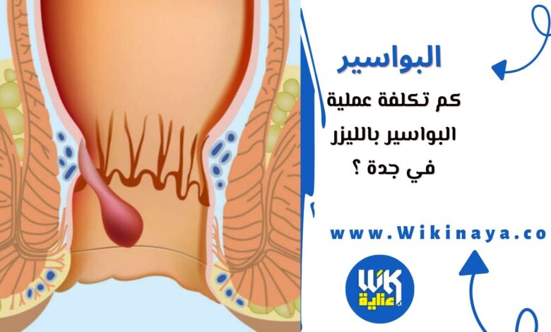 كم تكلفة عملية البواسير بالليزر في جدة ؟