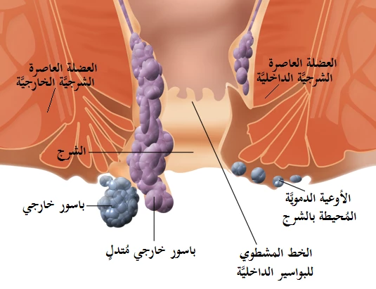 البواسير بالصور الطبيعية وانواعها ال 3 والأسباب الكامنة خلف ظهورها