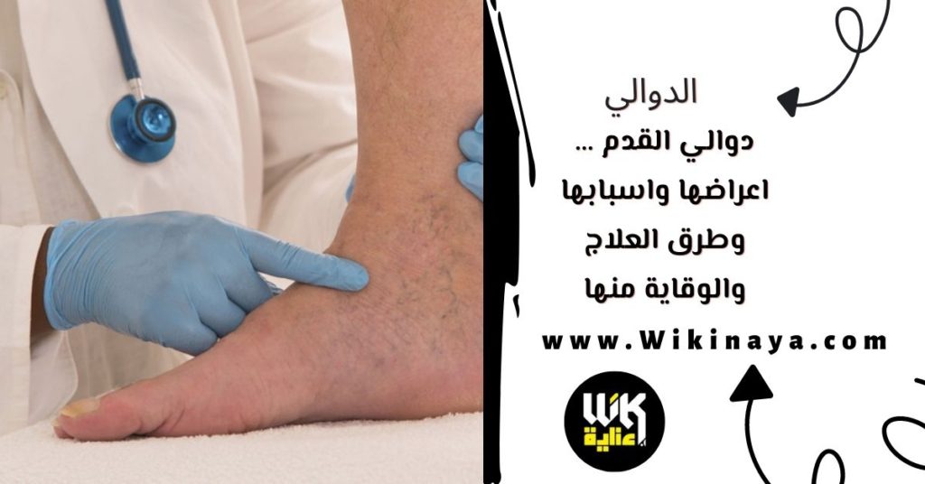 دوالي القدم … اعراضها واسبابها وطرق العلاج والوقاية منها