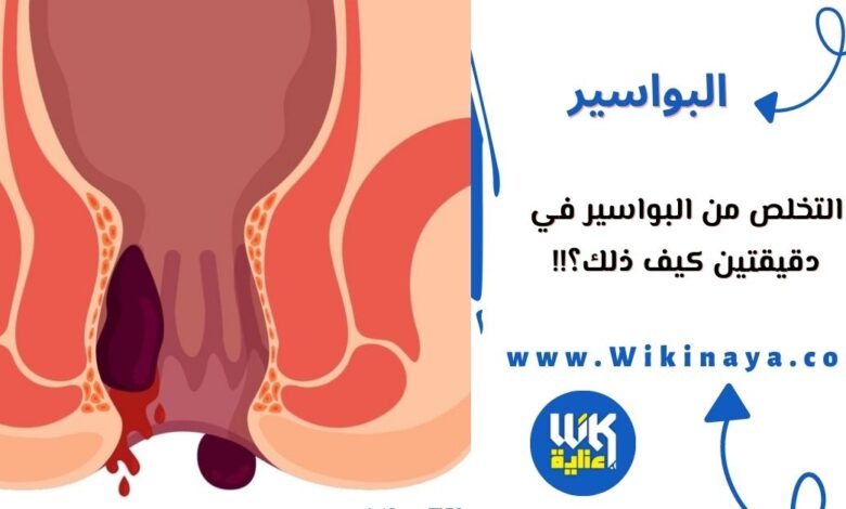 التخلص من البواسير في دقيقتين كيف ذلك؟!!