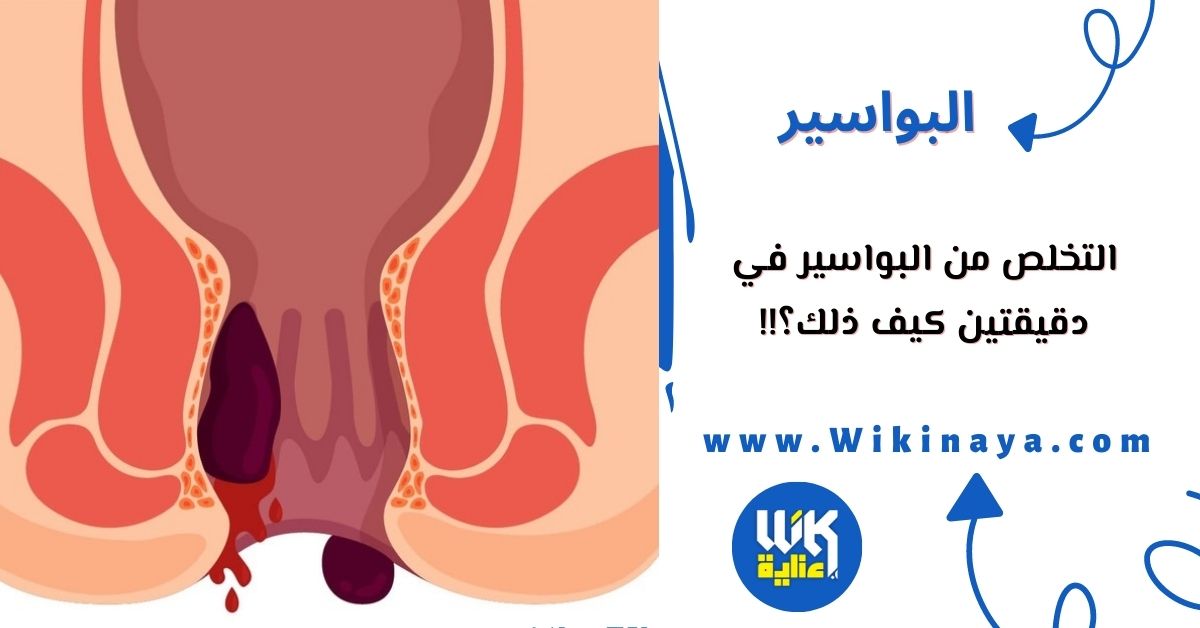 التخلص من البواسير في دقيقتين كيف ذلك؟!!