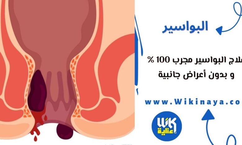 علاج البواسير مجرب 100 % و بدون أعراض جانبية