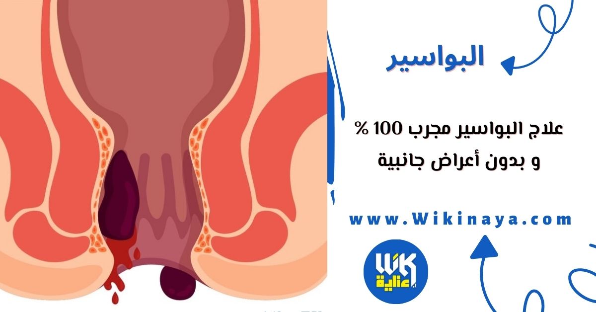 علاج البواسير مجرب 100 % و بدون أعراض جانبية