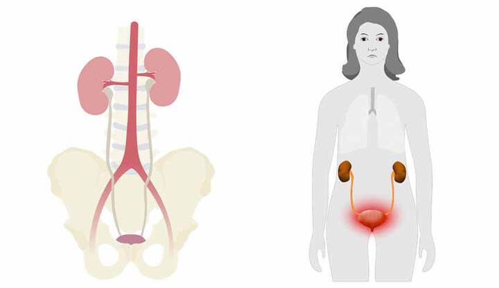 ما هي أسباب التهاب البول المتكرر ؟ و كيف يتم علاجه ؟