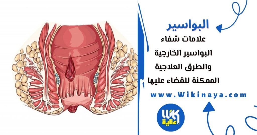 علامات شفاء البواسير الخارجية والطرق العلاجية الممكنة للقضاء عليها