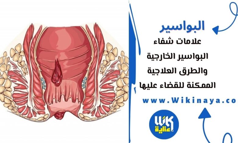 علامات شفاء البواسير الخارجية والطرق العلاجية الممكنة للقضاء عليها