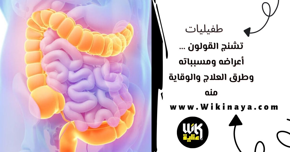 تشنج القولون ... أعراضه ومسبباته وطرق العلاج والوقاية منه