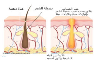 حبوب الشباب