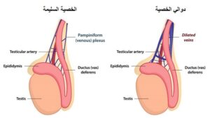 اعراض دوالي الخصية