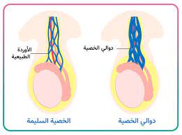 كيفية معرفة دوالي الخصية هل ظهور عروق فيها