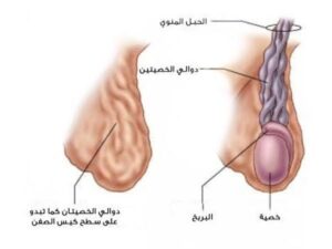 شكل دوالي الخصية بالصور