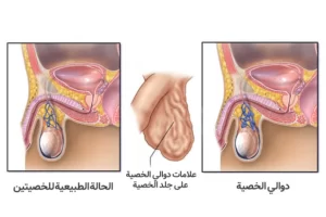 شكل دوالي الخصية بالصور