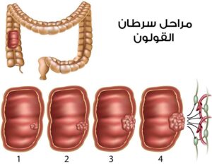 أعراض سرطان القولون في بدايته