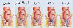 البواسير