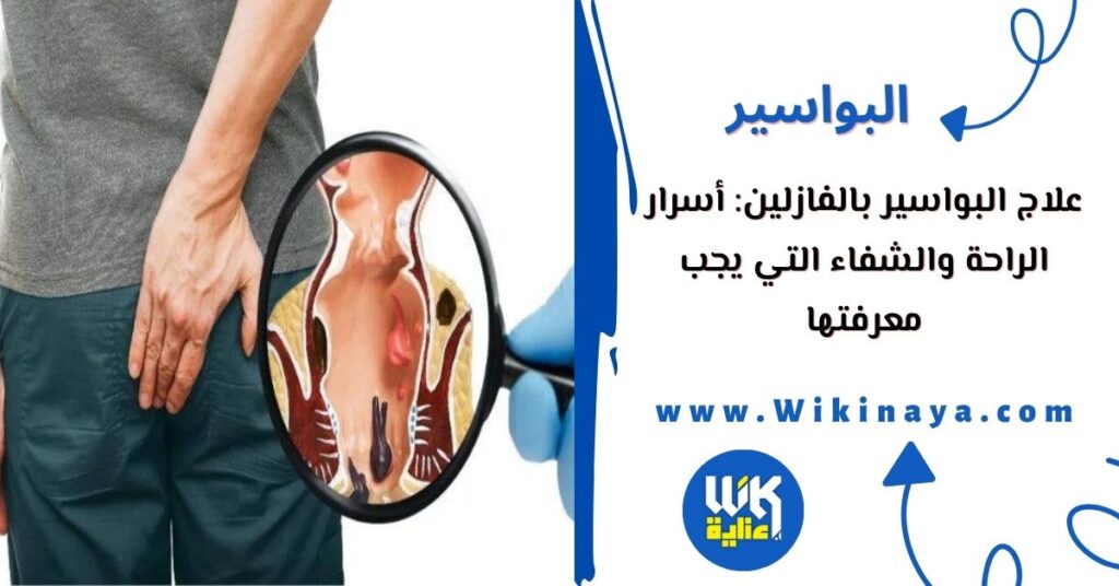 علاج البواسير بالفازلين